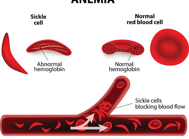 Sickle Cell Disease